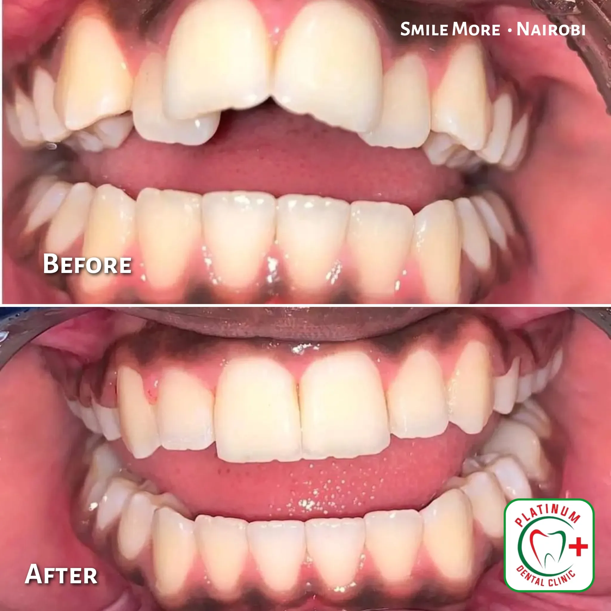 Braces before and after smile alignment