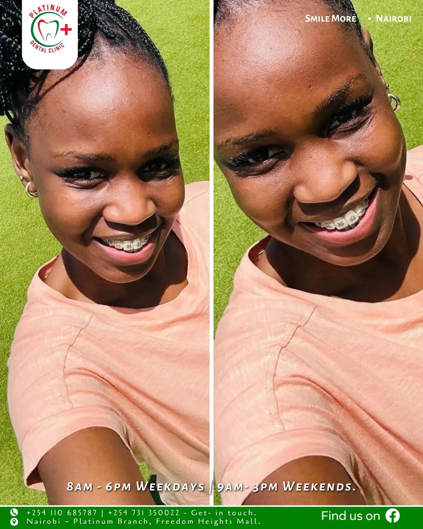 Braces journey smile transformation