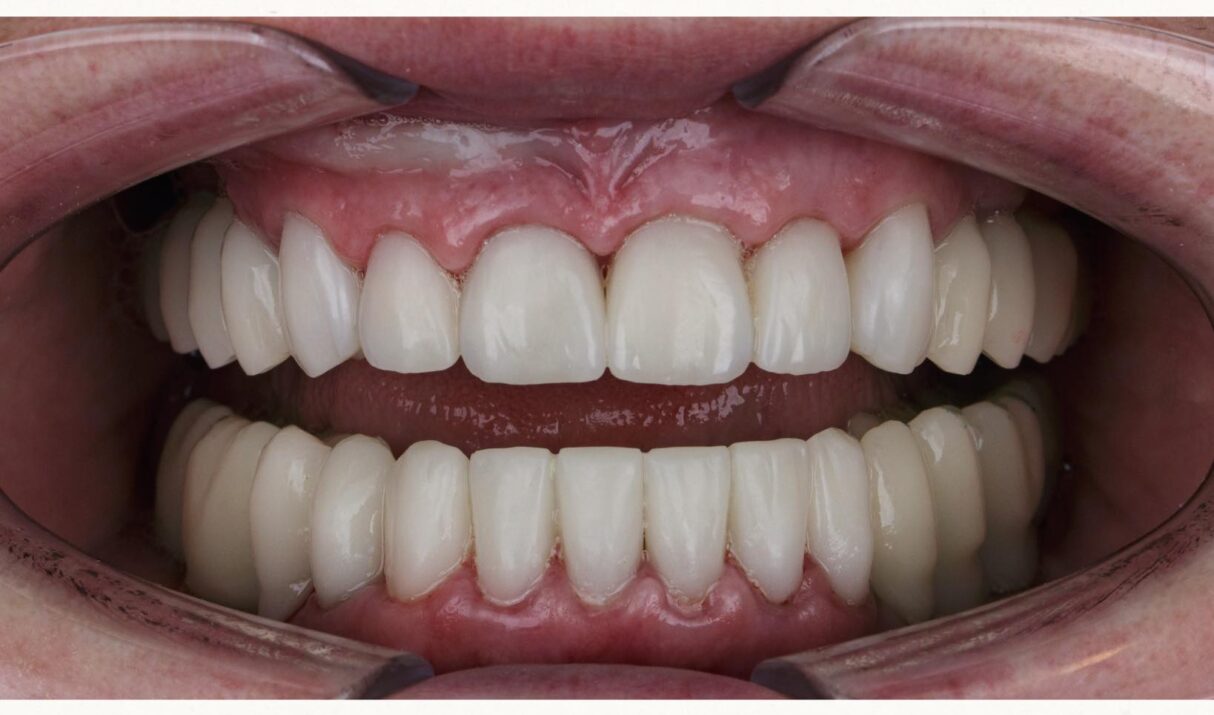 Dental Crown Cost in Kenya and Nairobi 2026
