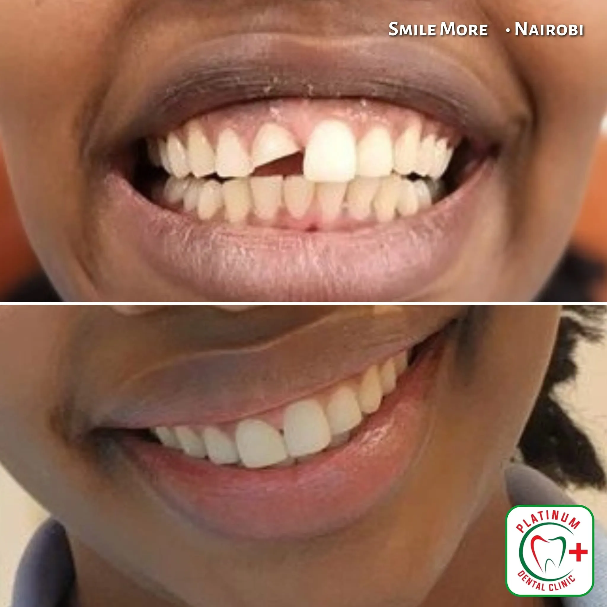 Dental filling smile repair before and after