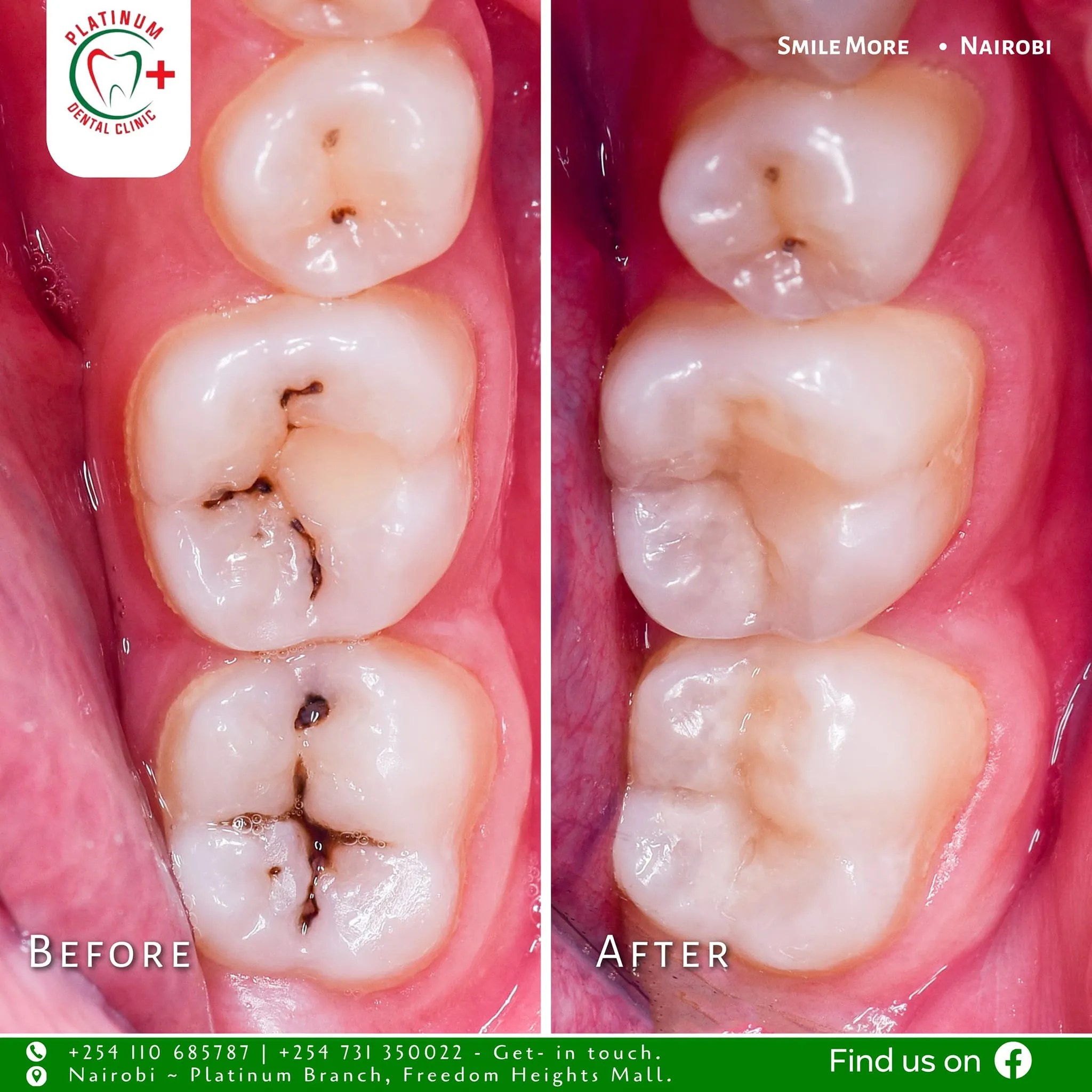 Dental fillings restoration result