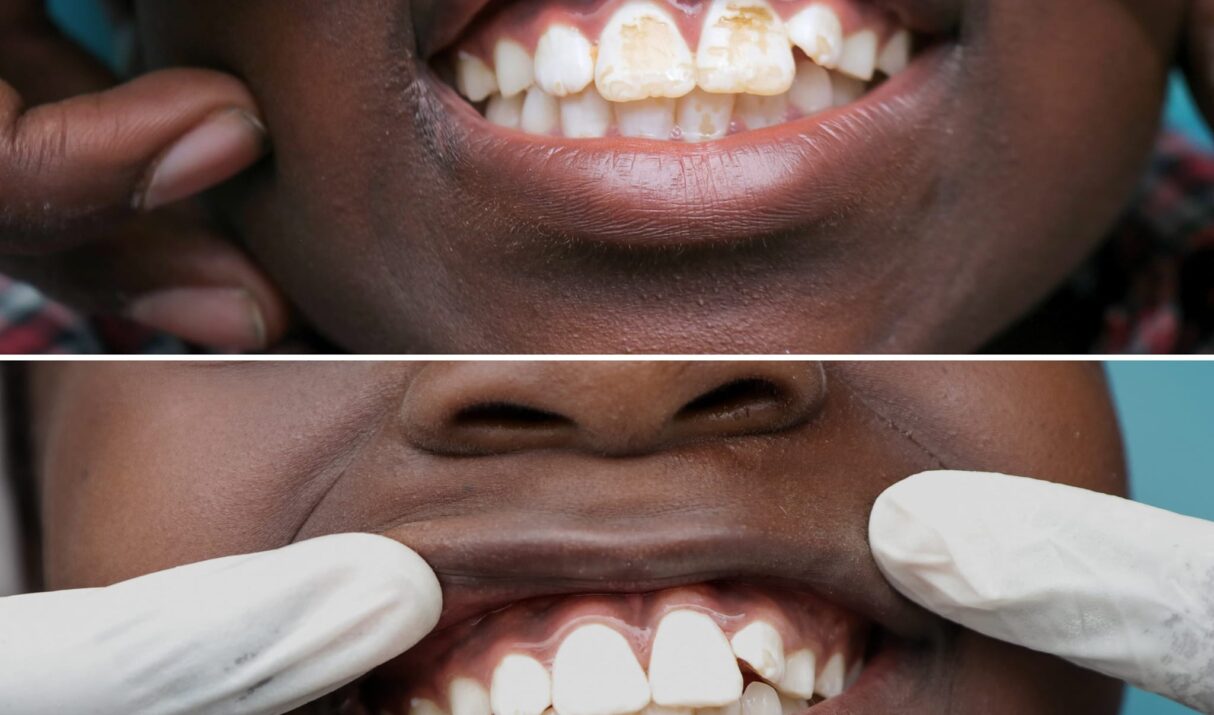 Teeth Cleaning Price in Nairobi