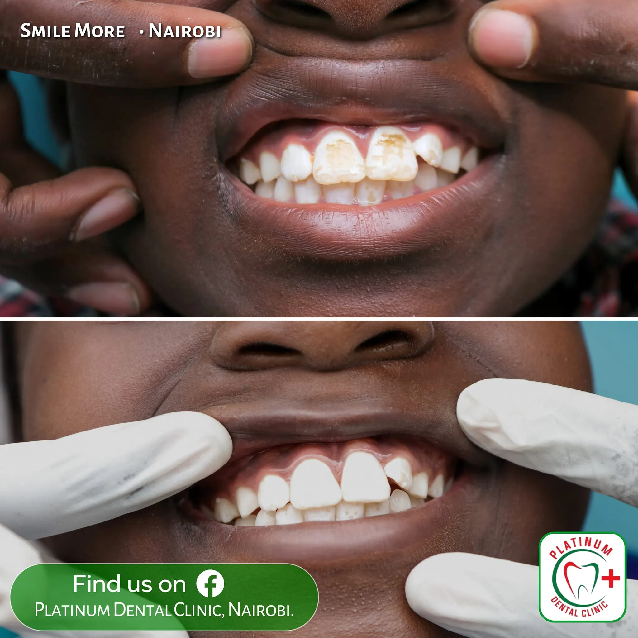 Full mouth scaling and cleaning result