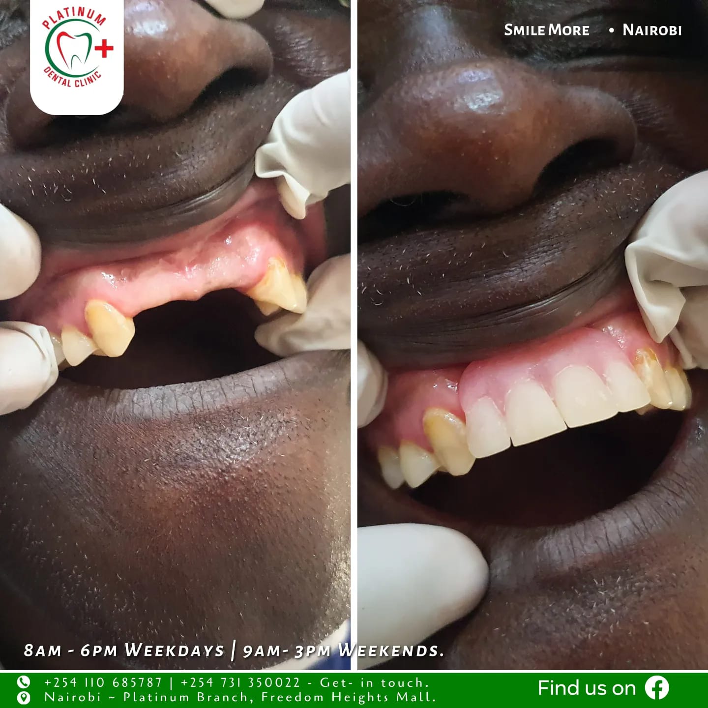 Dental replacement treatment Nairobi