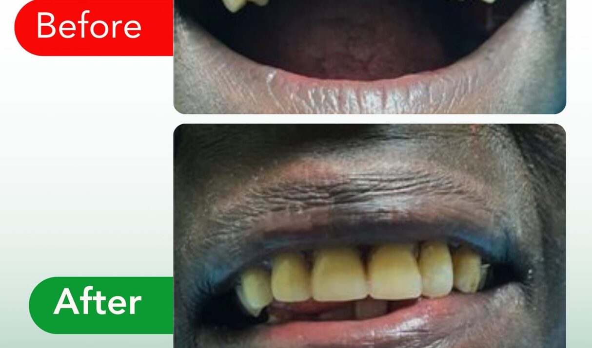 Dentures Cost in Kenya