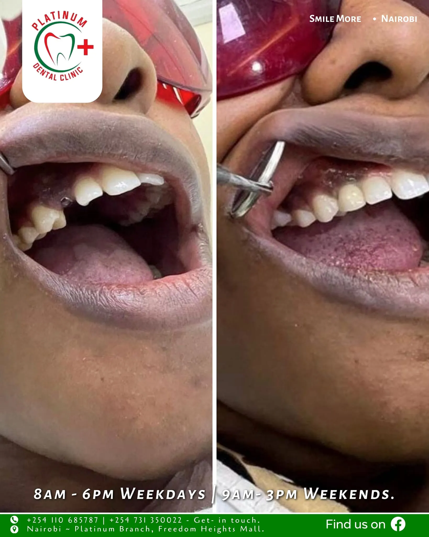 Tooth replacement smile transformation