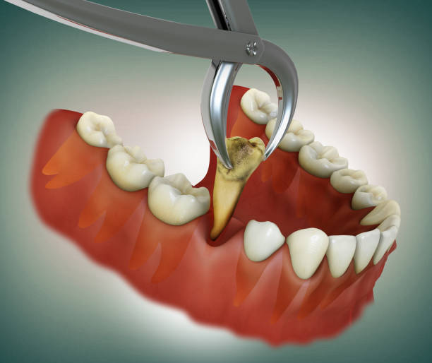 Wisdom Tooth Extraction Cost in Kenya
