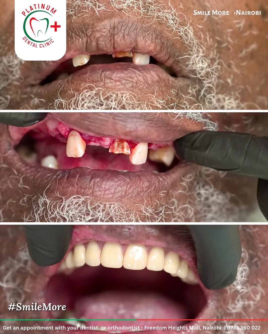 Teeth replacement before and after Nairobi