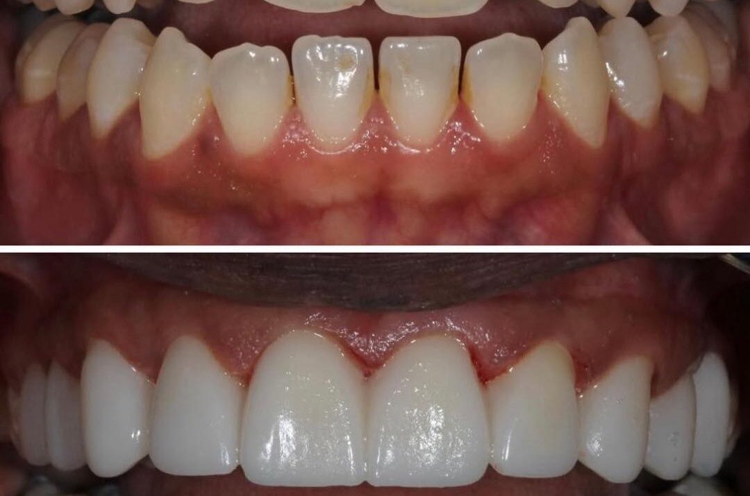 Teeth Whitening Cost in Nairobi & Kenya: Professional Whitening Price Guide