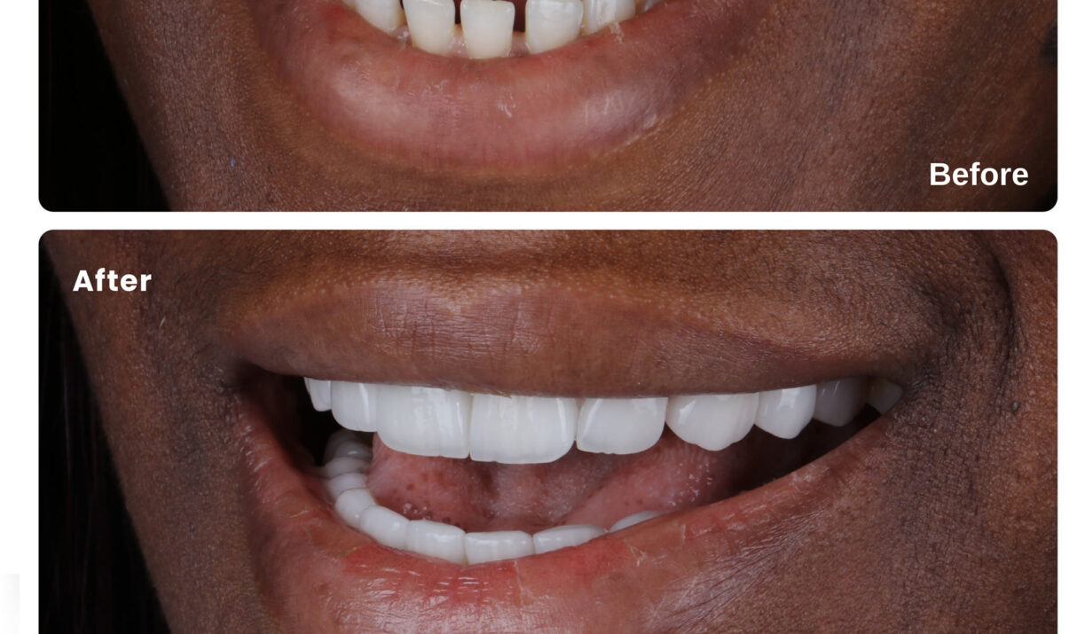 Dental Veneers Cost in Nairobi & Kenya: Composite vs Porcelain Veneer Price Guide