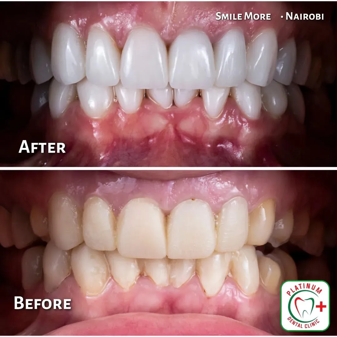 Teeth whitening before and after result