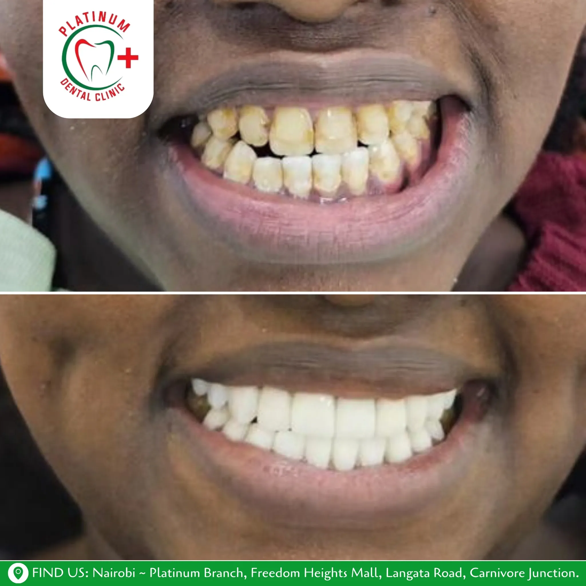 Professional teeth whitening smile result