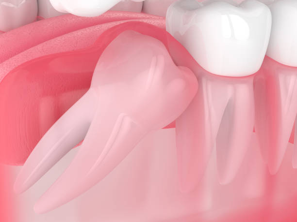 Wisdom Tooth Extraction Cost in Kenya & Nairobi: Simple vs Impacted Wisdom Tooth